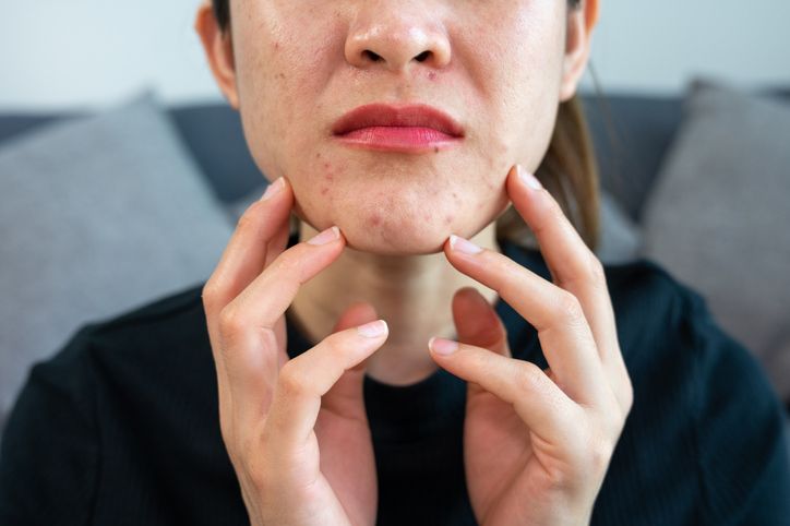 臉暗瘡爆發怎麼辦？一起來了解不同暗瘡位置對應的成因+5大常用的去暗瘡方案！