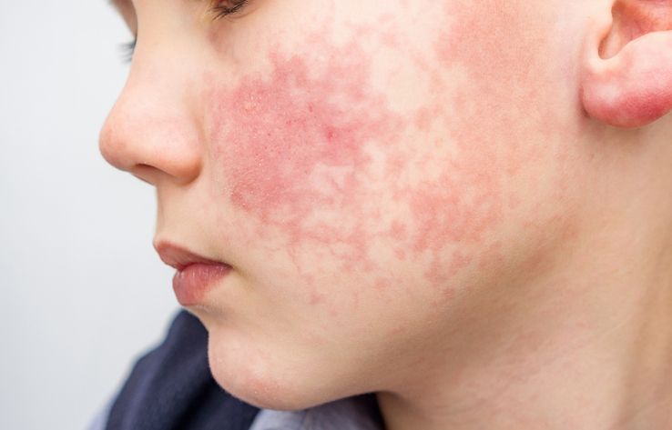 【皮膚紅點】是怎麽回事？一次分清蕁麻疹、濕疹和風疹區別！換季皮膚出紅疹該如何防範？