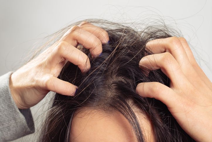 【頭皮護理】即使無脫髮問題，護理頭皮都需要做嗎？分享4個好習慣維持頭皮健康！