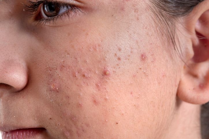 5款好用除疤膏推薦！細數除疤膏的常見成分+其它除疤方法！皮膚專家推薦「它」，根源處避免臉部疤痕形成！