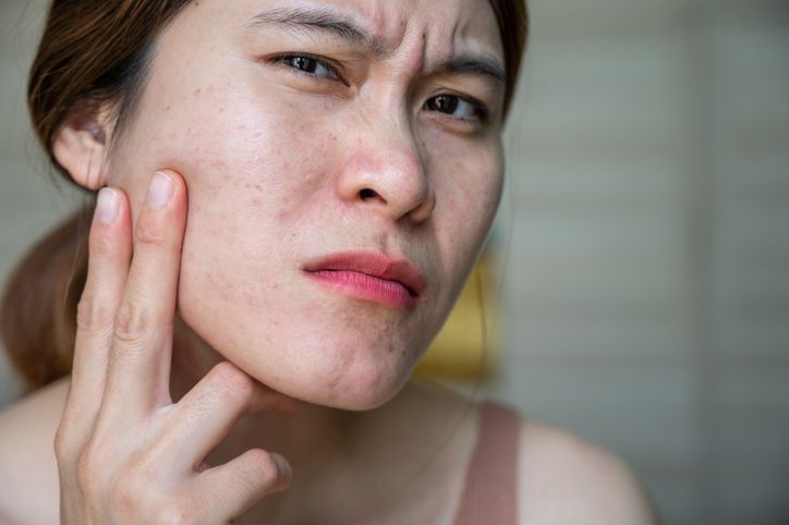 教你辨別不同位置「面部暗瘡」發出的健康警訊！簡單三招預防痘痘粉刺問題！